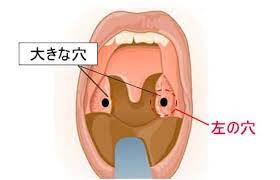 臭い玉 膿栓 の取り方 取る方法はコレだ ここに潜んでたのか 原因などについても簡単にまとめました 喉の見えない場所に大量にあっても大丈夫 膿栓 膿 健康
