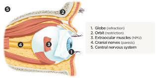 Double vision ophthalmology a condition whereby a single object appears as 2. Differential Diagnosis Of Diplopia Applied