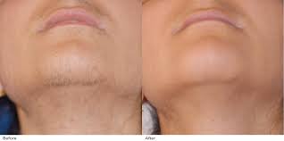 There are so many different ways to remove hair, it can be hard to actually figure out which one offers the grey hair, white & blonde hair colors and ipl hair removal. Hair Removal Before After Visual Results Dekalaser
