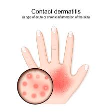 Image result for dermatitis contacta