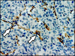 The lymph nodes, bones see how breast cancer metastasis affects the body, possible symptoms, and treatment. How Tumor Cells Create A Metastatic Niche New Work From The Oskarsson Lab Published In Nature Communications