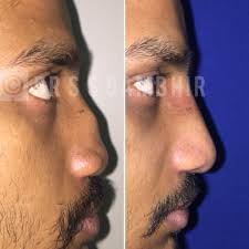 Get A Nose Job Done By Experts Rhinoplasty Is A Process To Transform The Nose Through Reshaping Bine And Cart Rhinoplasty Rhinoplasty Surgery Rhinoplasty Cost