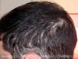 You need protein to prevent hair loss! After Starting Propecia I M Thinning On The Back And Sides Too Wrassman M D Baldingblog