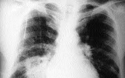 Mucormicosis rinocerebral asociada a agranulocitosis más diabetes mellitus: Http Www Reviberoammicol Com 2002 19 052056 Pdf