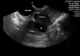 Ultrasound imaging of the pelvis uses sound waves to produce pictures of the structures and organs in the lower abdomen and pelvis. Abdominal Pain In Nonpregnant Female Patients 2014 04 06 Ahc Media Continuing Medical Education Publishing