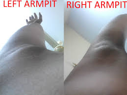 They feel hard (like an olive or a pea under your skin). Lump Under My Armpit Breast Cancer Now Forum 1070685