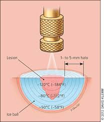 Cutaneous Cryosurgery American Family Physician