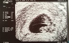 Lesen sie hier mehr zum thema schwangerschaftstest! Plotzlich Zwillinge 1 Wie Es Ist Mit Zwei Babys Schwanger Zu Sein Da Hog N Onlinemagazin Ausm Woid