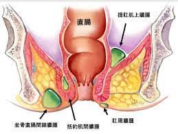 肛門膿腫| 悉尼大腸外科醫生
