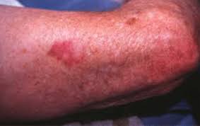 Beauty and personal care, body, creams, moisturizers, skin care share: Racgp Nonmelanoma Skin Cancers Treatment Options