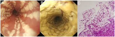 The esophagus is a tube composed of a mucosal lining, and longitudinal and circular smooth muscle fibers. Endoscopic Findings A B And Pathological Findings C Of Candida Download Scientific Diagram