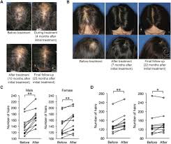 Stem cell treatment for hair loss philippines it's been theorised for years, but now human stem … cells and confirmed their ability to induce hair growth when. Current Advances In Stem Cell Based Therapies For Hair Regeneration Sciencedirect