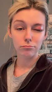 Social media star claims TikTok ban 'gave her shingles and left her blind  in one eye'