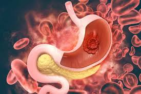 Gastritis kronis korpus ( gastritis tipe a). Gastritis Merupakan Panyakit Karena Gangguan Apa Itu Sakit Maag Ateja News Gastritis Merupakan Suatu Peradangan Atau Pendarahan Pada Mukosa Lambung Yang Penyebabnya Oleh Faktor Iritasi Infeksi Dan Ketidakteraturan Gastritis
