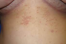 Image result for scabies human bites