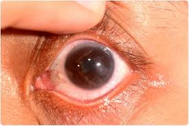 Image result for Keratitis