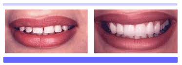 Discover the most modern transparent aligner system worldwide and transform your smile. Top 10 Orthodontic Braces Myths Orthodontistphx