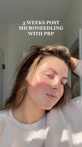 One of our all time fave treatments! Microneedling + PRP 😍 “What I notice  most: how even my complexion is, how glowy i am, how plump my skin is, how  “lifted” my face feels & how smooth my skin is!” ...
