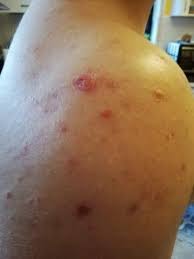 Maybe you would like to learn more about one of these? Probleme Mit Pickel Im Rucken Und Schulterbereich Hautprobleme