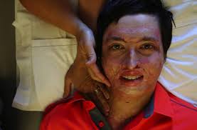 Long recovery: Firefighter slowly healing from burns over 70 percent of his  body