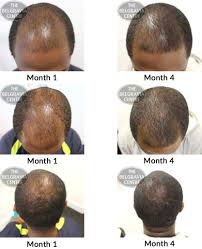 The hair follicle is what anchors the hair to your skin. Hair Growth Success I M Super Happy I Even Recommended My Friend