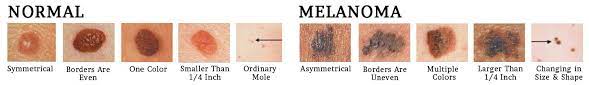 If you have skin cancer, it is important to know which type you have because it affects your treatment options and your outlook (prognosis). Skin Cancer Treatment Florida Dermatology Skin Cancer Centers