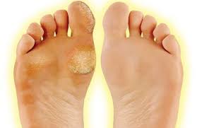 Calluses Are Generally Not Harmful But May Sometimes Lead To Other Issues Such As Infection Or Skin Ulceration Y In 2020 Dry Skin On Feet Foot Callus Callus Removal