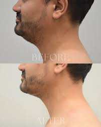 A sharper jawline starts here. Neck liposuction for a more defined,  masculine profile. 📐🔥Confidence looks good