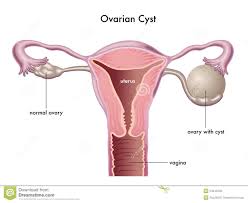 Znalezione obrazy dla zapytania Cysta
