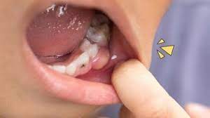 Gigi berlubang adalah kondisi ketika gigi membusuk karena makanan sisa tertinggal pada gigi. 5 Penyebab Dan Cara Mengatasi Gusi Bengkak Pada Anak Jangan Panik Dulu Orami