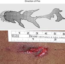 A.50 calibre bullet would have took my arm off so i guess i'm lucky i was just stabbed. Forensic Emergency Medicine Clinical Gate