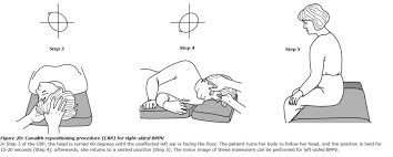 How often do you have to travel to america on business? Canalith Repositioning Procedure For Bppv Veda