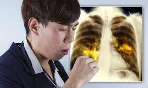 Common symptoms and signs include cough, chest pain, coughing up blood, and wheezing. Lung Cancer Symptoms All 14 Most Common Signs Of Lung Cancer Full List Sound Health And Lasting Wealth