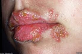 Image result for Herpes Simplex