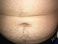 In women, the two most common causes of hirsutism are polycystic ovary syndrome (pcos) and idiopathic hirsutism. Abdominal Hair Wikipedia