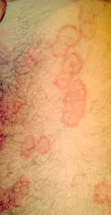 Image result for Eczema nummulare