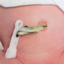 مراحل سقوط سرة الطفل بالصور ويب طب