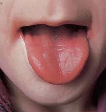 Image result for Angular Stomatitis