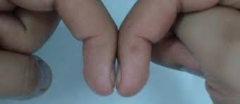 People with adrenal gland involvement may sometimes complain of kidney pain on one side of their back, or describe a feeling like they've just. How Your Fingernails Could Point The Way To An Early Diagnosis Roy Castle Lung Cancer Foundation