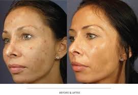 Chemical Peels Houston Henry fantastic Mentz