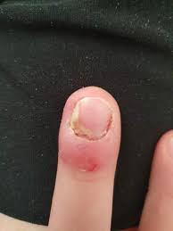Mein Nagel Lost Sich Gesundheit Und Medizin Nagel Fingernagel