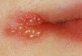 There's nothing like a cold sore for ruining your mood and knocking your confidence. Cold Sores Pictures Of What They Look Like