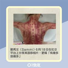 鄭秀文官方專頁sammi cheng 's official page. åˆ®ç—§åŠŸæ•ˆ é¡è‰² ç¦å¿Œ æ²»æ„Ÿå†'å¤±çœ é¼»æ•æ„Ÿç—›å°±æœ‰æ•ˆ 4éƒ¨ä½å‹¿æŽ‚