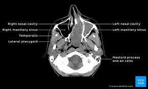 Polyps can form as the result of allergic conditions or of inflammation and infection. Schwannoma Of The Nasal Cavity Clinical Case Diagnosis Kenhub