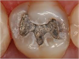 Oral Health Groups Debate Dental Amalgam During FDA Hearing – Dentistry  Today