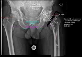 Muss bei coxarthrose und einer hüftnekrose unbedingt operiert werden (d.h. Huftgelenk Operation Der Richtige Zeitpunkt Und Ablauf Klinik Pyramide