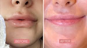 How Hyalase (Hyaluronidase) Can Help | Bloomskin New Zealand