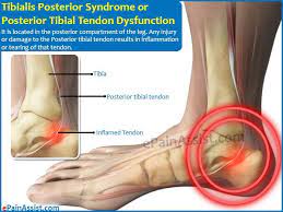 Tibialis Posterior Syndrome Jpg 600 450 Posterior Tibial Tendonitis Tendonitis Symptoms Leg Injury