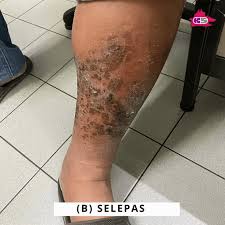 Fungal / kulat pada kulit. Cara Rawatan Cellulitis Jangkitan Pada Kulit Kaki Penghidap Kencing Manis Klinik Sabah