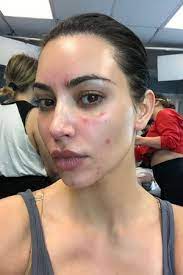 Porque é que a psoríase aparece? O Que E A Psoriase Doenca De Pele De Kim Kardashian Donna